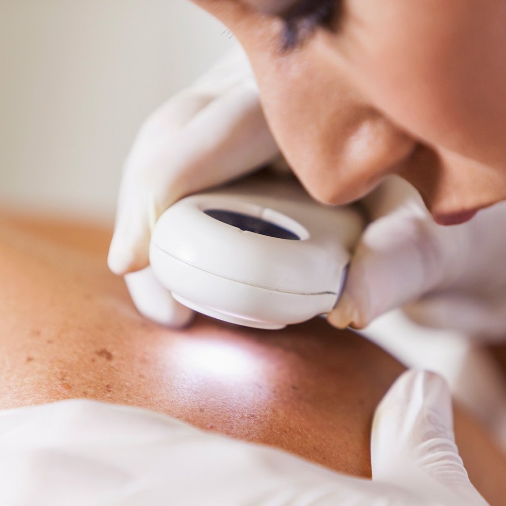 A close-up view shows a healthcare professional, wearing white gloves, using a dermatoscopic device to examine moles or skin imperfections on a patient's back. A bright light emanates from the device, illuminating the skin being inspected.